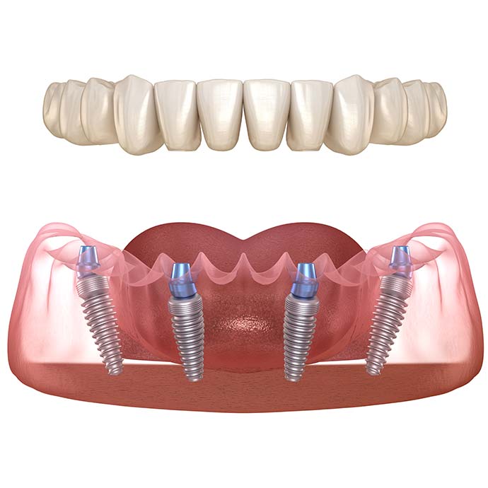 All-on-4 Methode. Kompletter Zahnersatz in nur einem Tag und ohne Schmerzen bei Dental-Clinic-Biel