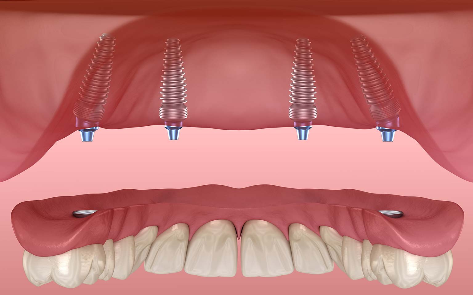 All-on-4 Methode. Kompletter Zahnersatz in nur einem Tag und ohne Schmerzen bei Dental-Clinic-Biel